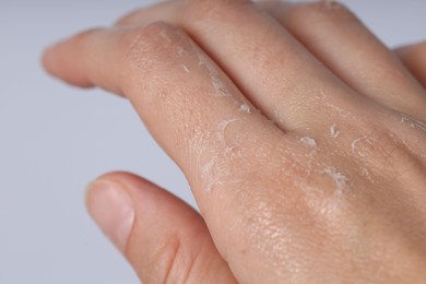 Photo of Woman with dry skin on her hand against light background, closeup