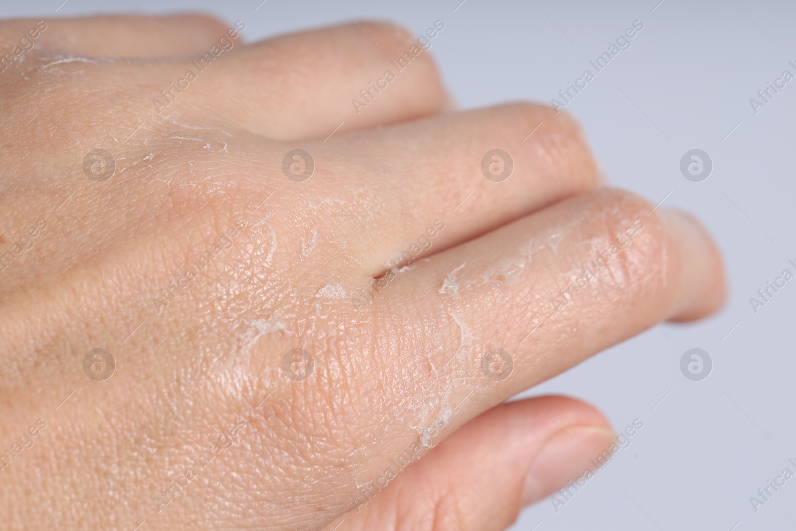 Photo of Woman with dry skin on her hand against light background, closeup