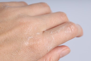 Photo of Woman with dry skin on her hand against light background, closeup