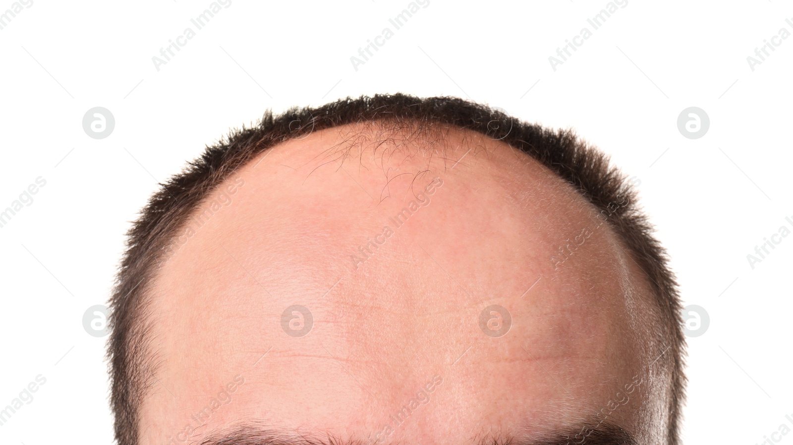 Photo of Baldness problem. Man with receding hairline on white background, closeup
