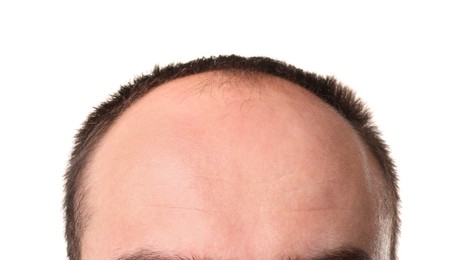 Photo of Baldness problem. Man with receding hairline on white background, closeup