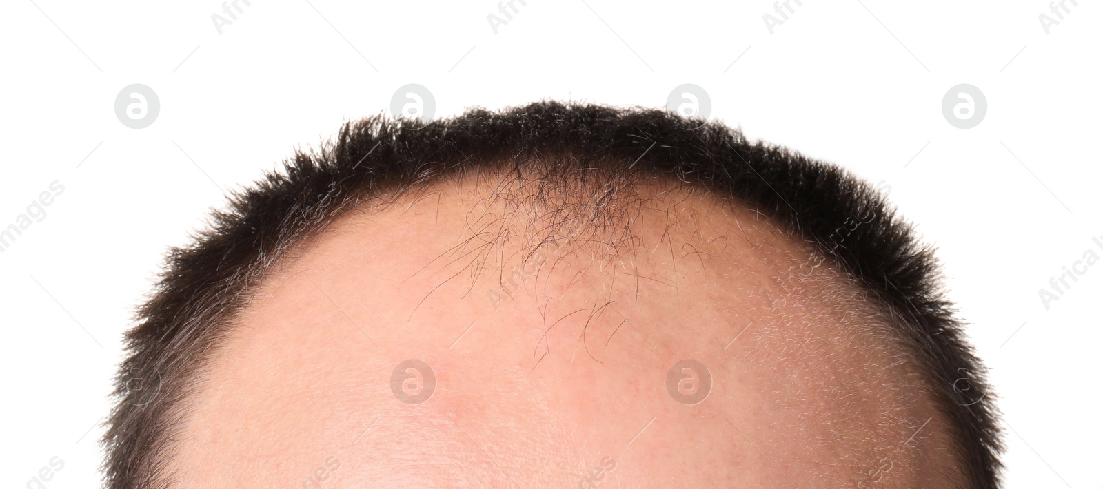 Photo of Baldness problem. Man with receding hairline on white background, closeup