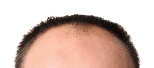 Photo of Baldness problem. Man with receding hairline on white background, closeup