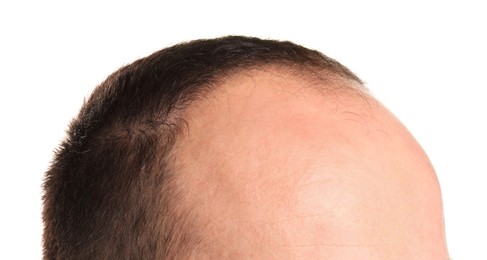 Photo of Baldness problem. Man with receding hairline on white background, closeup