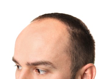 Photo of Baldness problem. Man with receding hairline on white background, closeup