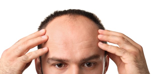 Photo of Baldness problem. Man with receding hairline on white background, closeup