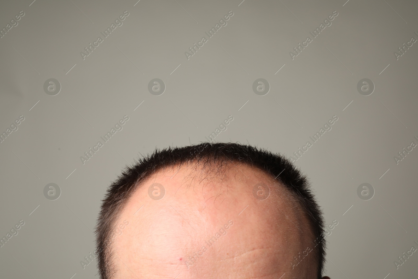 Photo of Baldness problem. Man with receding hairline on grey background, closeup