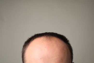 Photo of Baldness problem. Man with receding hairline on grey background, closeup
