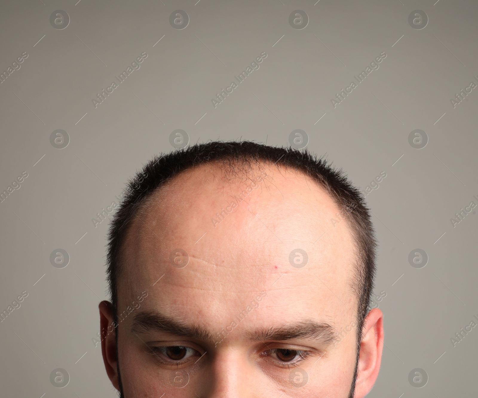 Photo of Baldness problem. Man with receding hairline on grey background, closeup