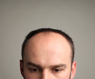 Photo of Baldness problem. Man with receding hairline on grey background, closeup