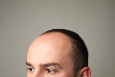 Photo of Baldness problem. Man with receding hairline on grey background, closeup