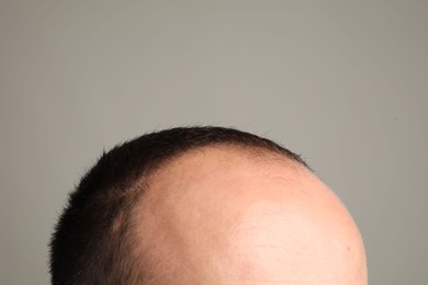 Photo of Baldness problem. Man with receding hairline on grey background, closeup