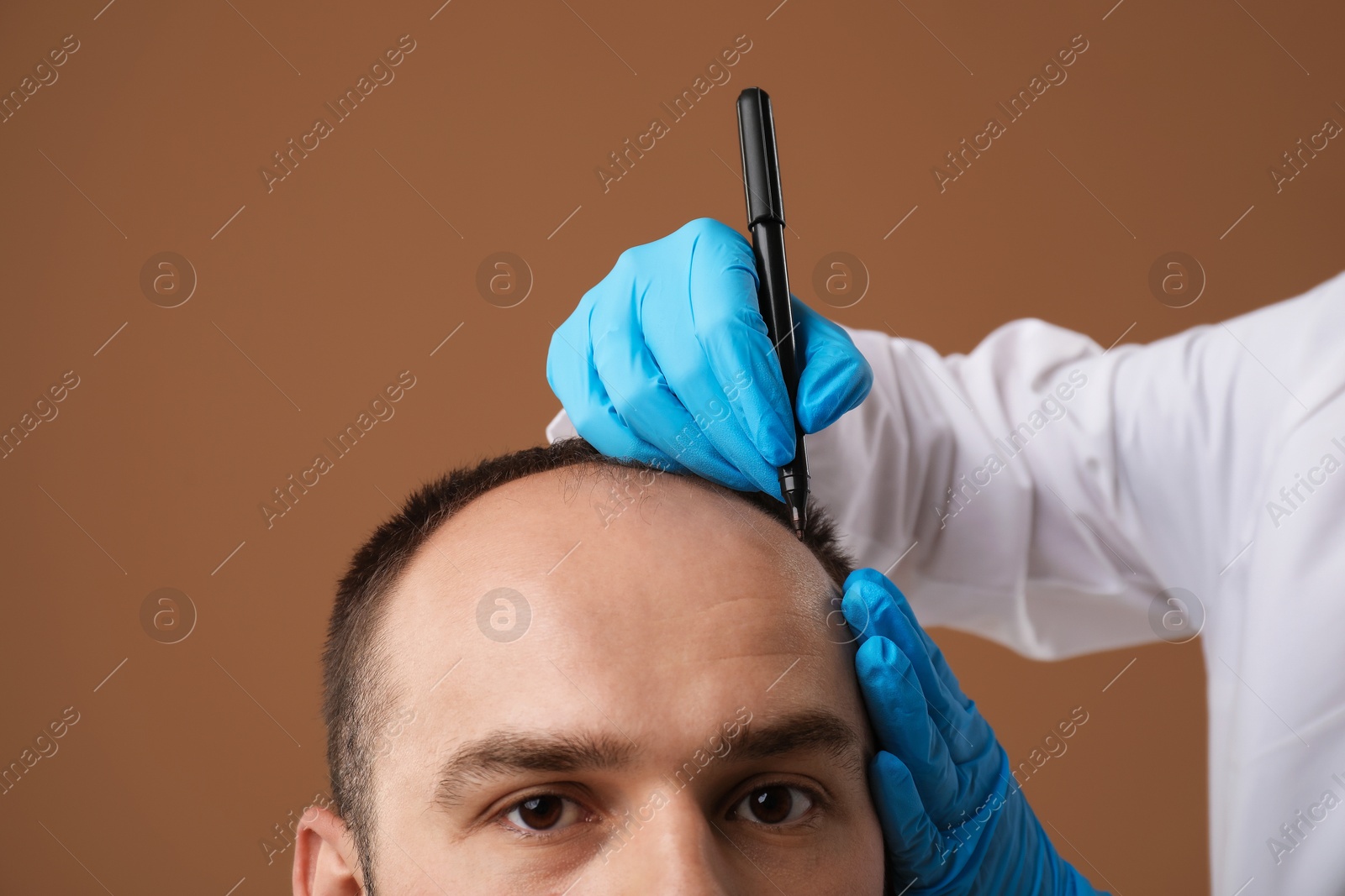 Photo of Baldness problem. Doctor in medical gloves drawing marks on patient's head before hair transplant surgery against brown background, closeup