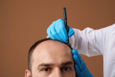 Photo of Baldness problem. Doctor in medical gloves drawing marks on patient's head before hair transplant surgery against brown background, closeup