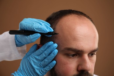 Photo of Baldness problem. Doctor in medical gloves drawing marks on patient's head before hair transplant surgery against brown background, closeup