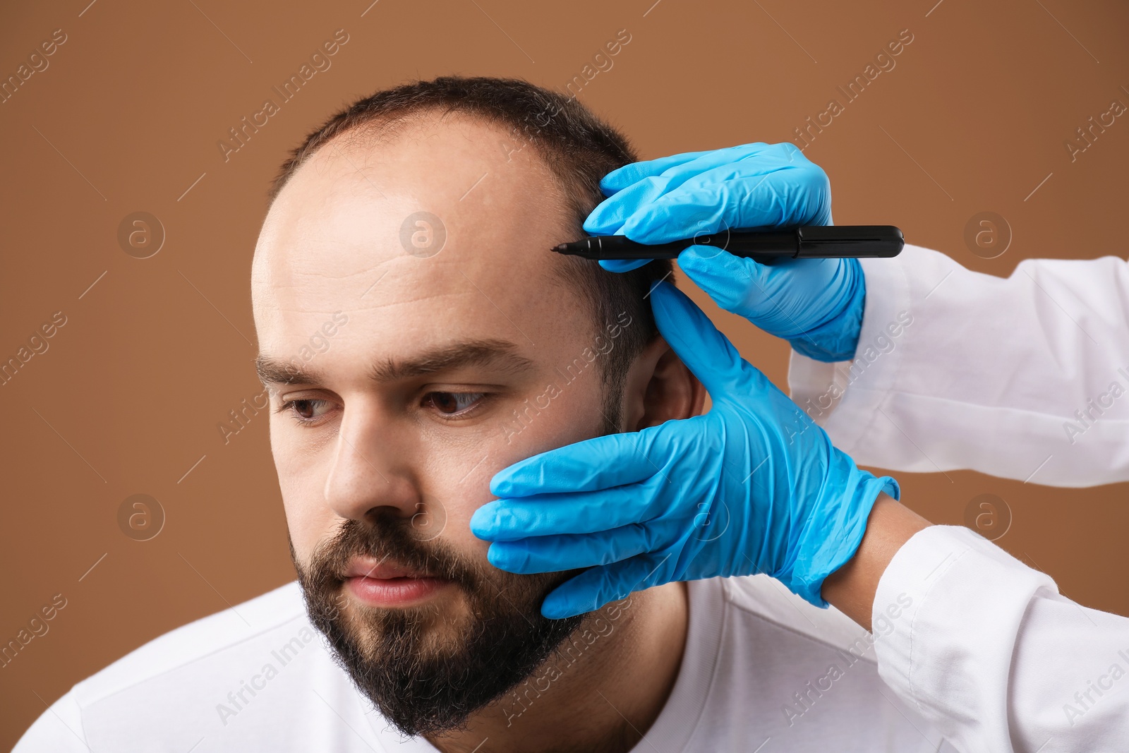 Photo of Baldness problem. Doctor in medical gloves drawing marks on patient's head before hair transplant surgery against brown background, closeup