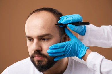 Photo of Baldness problem. Doctor in medical gloves drawing marks on patient's head before hair transplant surgery against brown background, closeup