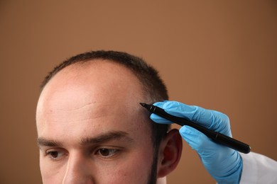 Photo of Baldness problem. Doctor in medical gloves drawing marks on patient's head before hair transplant surgery against brown background, closeup