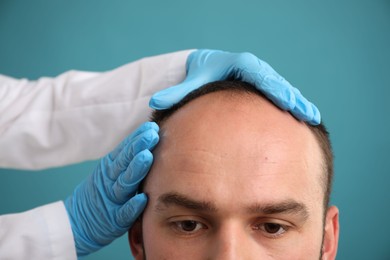 Photo of Baldness problem. Doctor in medical gloves examining patient's head against light blue background, closeup