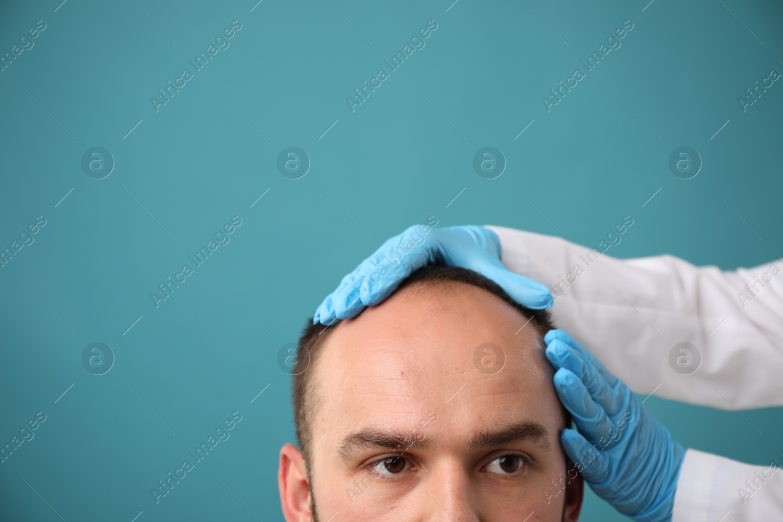 Photo of Baldness problem. Doctor in medical gloves examining patient's head against light blue background, closeup. Space for text