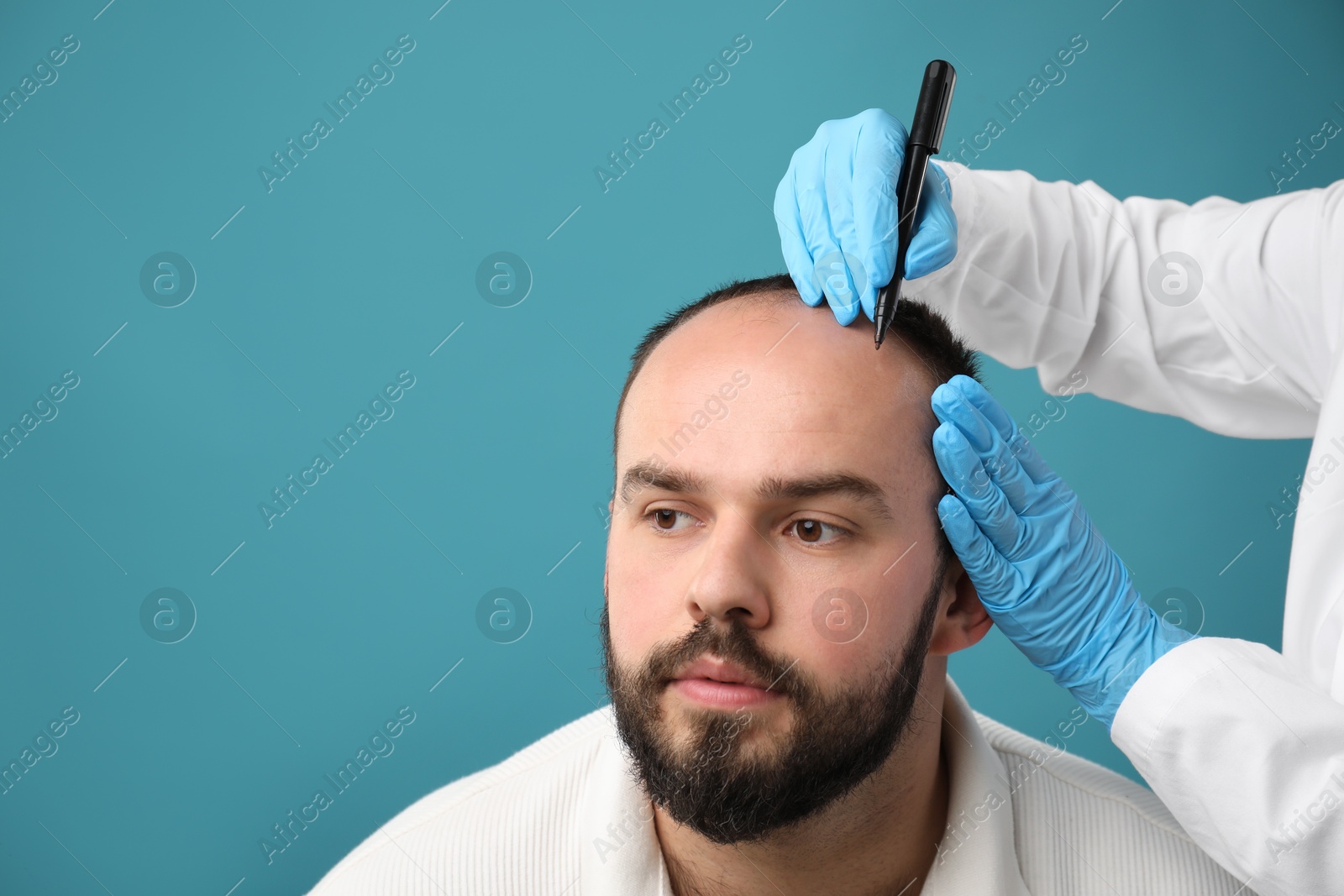 Photo of Baldness problem. Doctor in medical gloves drawing marks on patient's head before hair transplant surgery against light blue background, closeup. Space for text