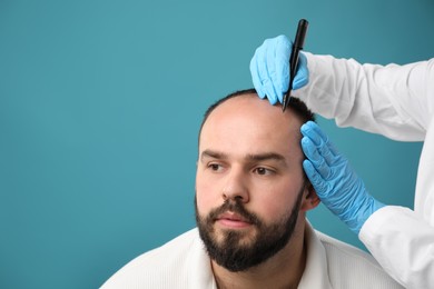 Photo of Baldness problem. Doctor in medical gloves drawing marks on patient's head before hair transplant surgery against light blue background, closeup. Space for text