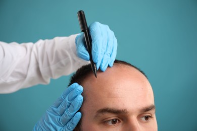 Photo of Baldness problem. Doctor in medical gloves drawing marks on patient's head before hair transplant surgery against light blue background, closeup