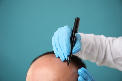 Photo of Baldness problem. Doctor in medical gloves drawing marks on patient's head before hair transplant surgery against light blue background, closeup. Space for text