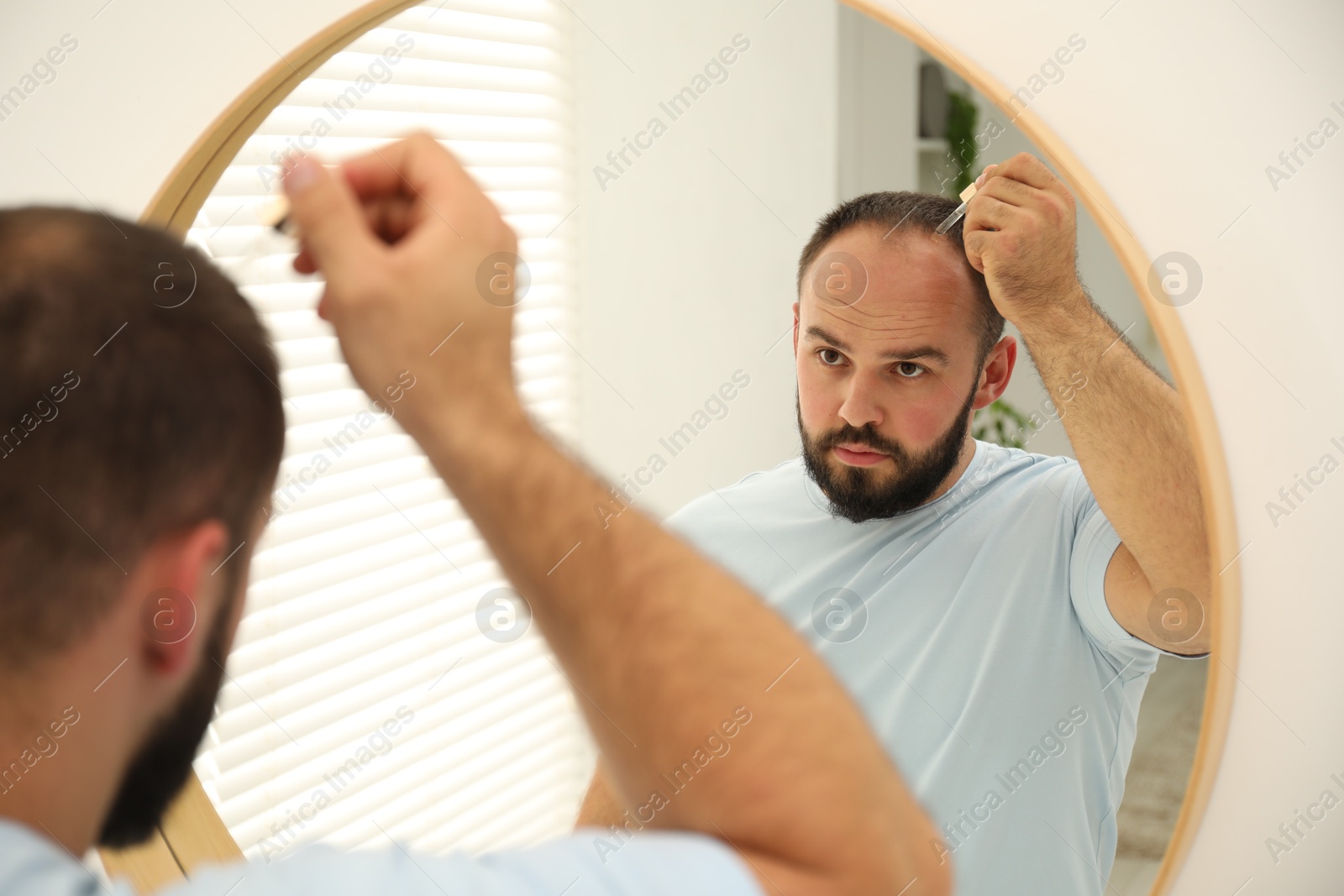 Photo of Baldness treatment. Man applying serum onto his hair near mirror at home
