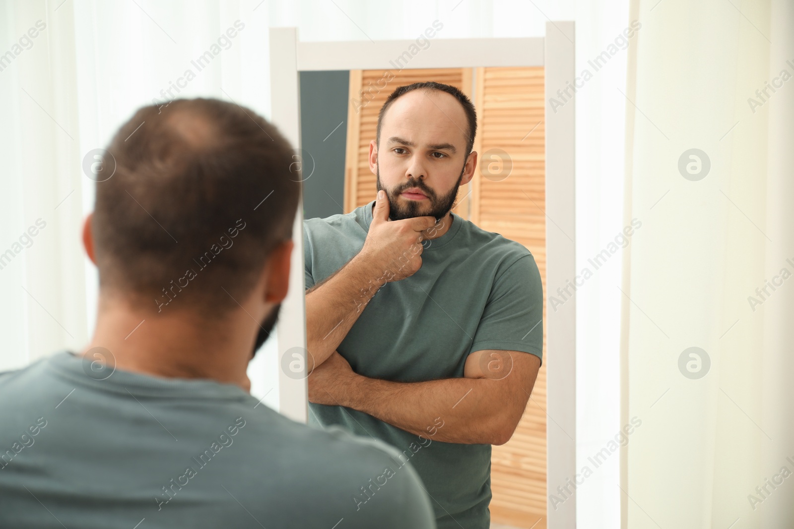 Photo of Baldness problem. Man with receding hairline near mirror at home