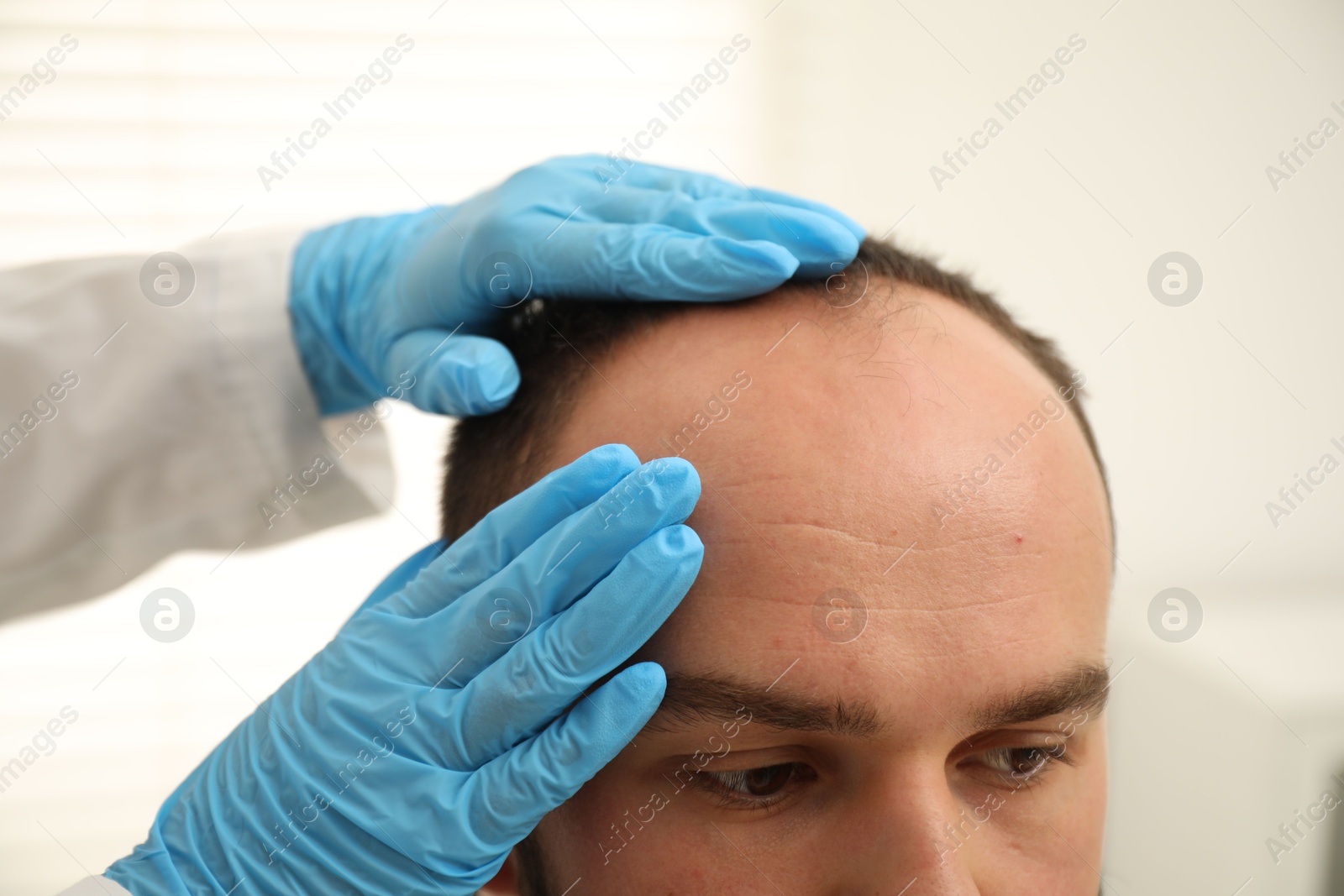 Photo of Baldness problem. Doctor in medical gloves examining patient's head in clinic, closeup