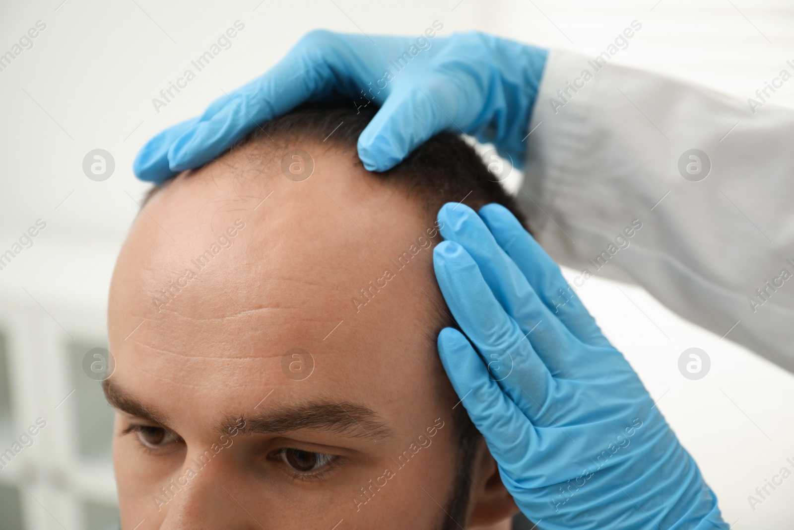 Photo of Baldness problem. Doctor in medical gloves examining patient's head in clinic, closeup