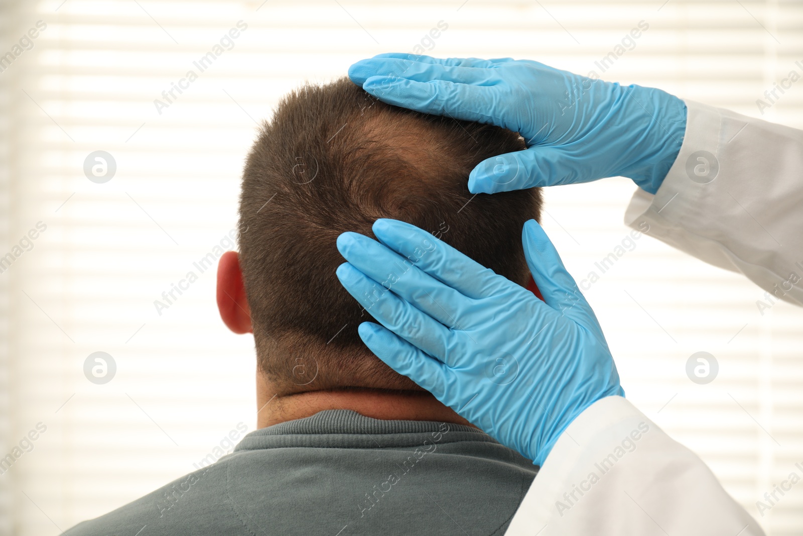Photo of Baldness problem. Doctor in medical gloves examining patient's head in clinic, closeup