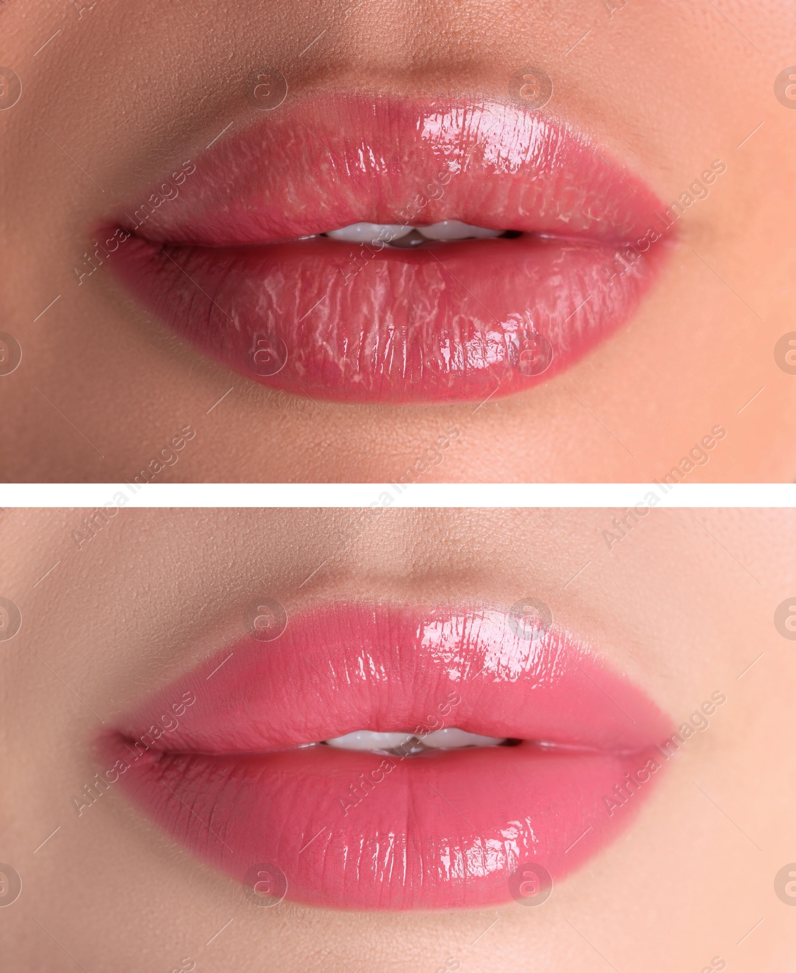 Image of Lip care. Woman with chapped and dry skin before and healthy skin after moisturizing treatment, collage