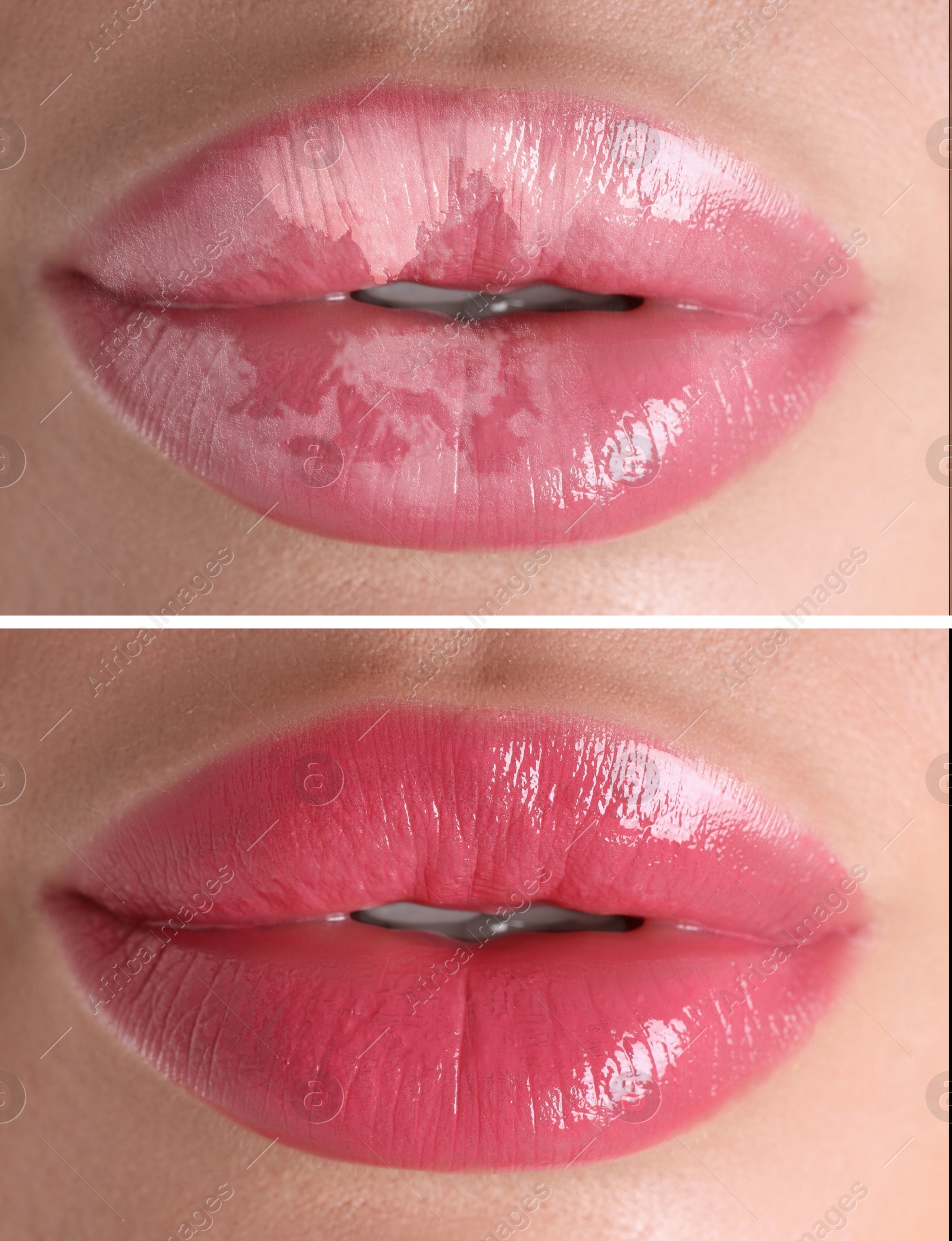 Image of Lip care. Woman with chapped and dry skin before and healthy skin after moisturizing treatment, collage