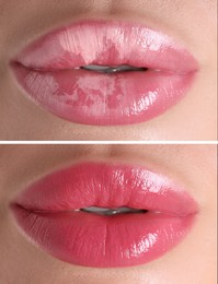 Image of Lip care. Woman with chapped and dry skin before and healthy skin after moisturizing treatment, collage