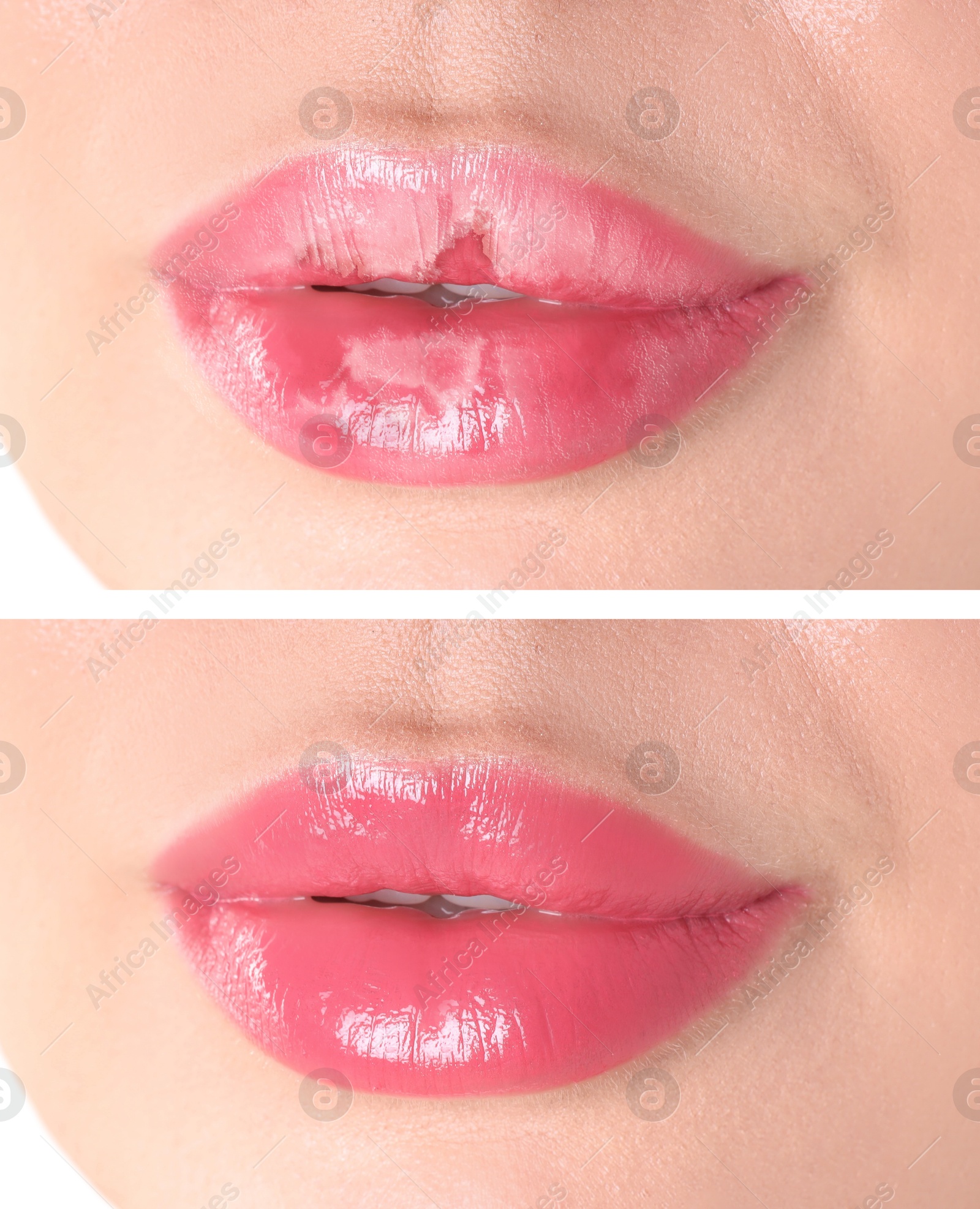 Image of Lip care. Woman with chapped and dry skin before and healthy skin after moisturizing treatment, collage