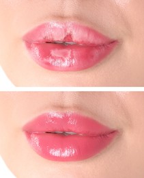 Image of Lip care. Woman with chapped and dry skin before and healthy skin after moisturizing treatment, collage