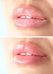 Image of Lip care. Woman with chapped and dry skin before and healthy skin after moisturizing treatment, collage