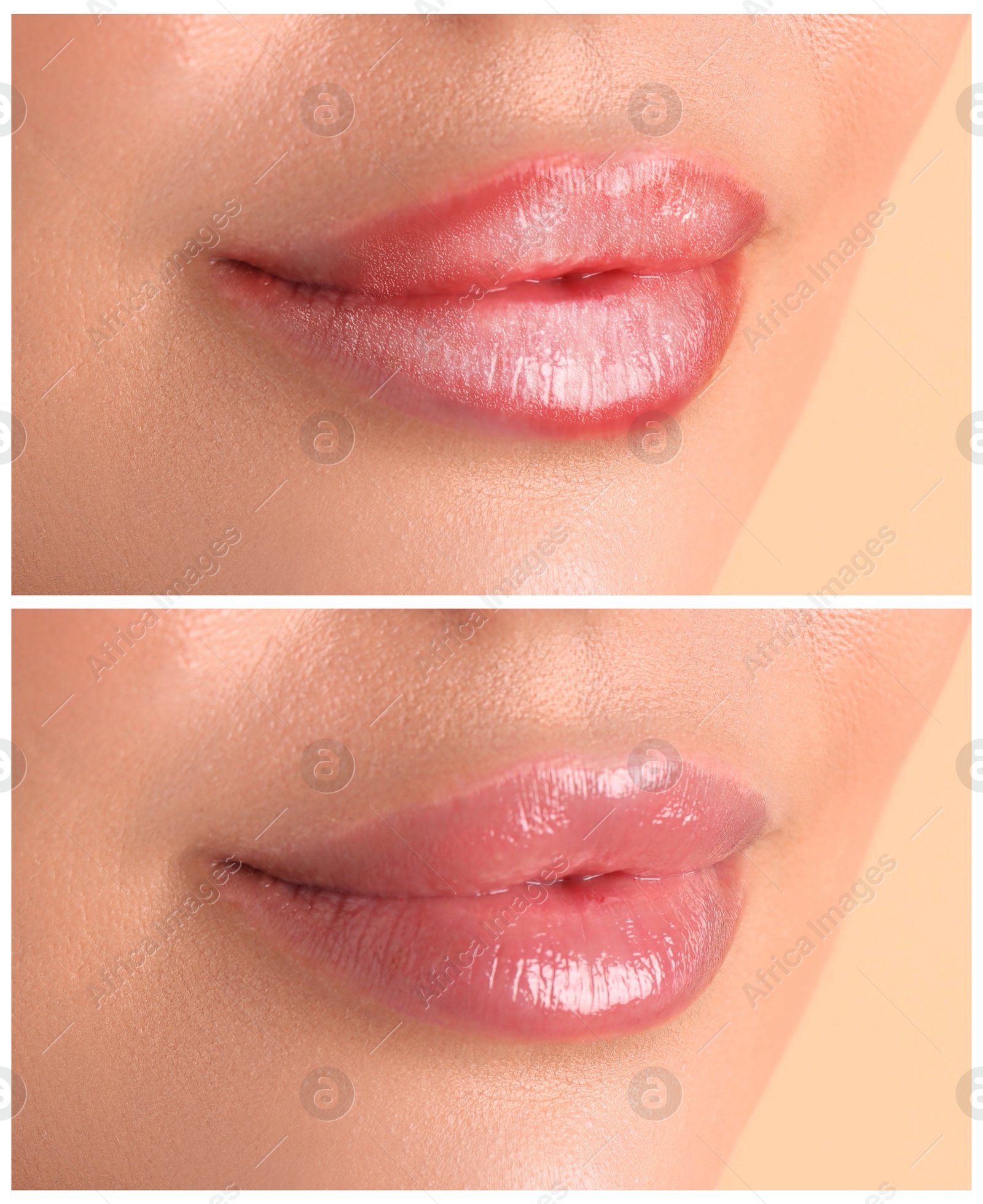 Image of Lip care. Woman with chapped and dry skin before and healthy skin after moisturizing treatment, collage