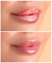 Image of Lip care. Woman with chapped and dry skin before and healthy skin after moisturizing treatment, collage