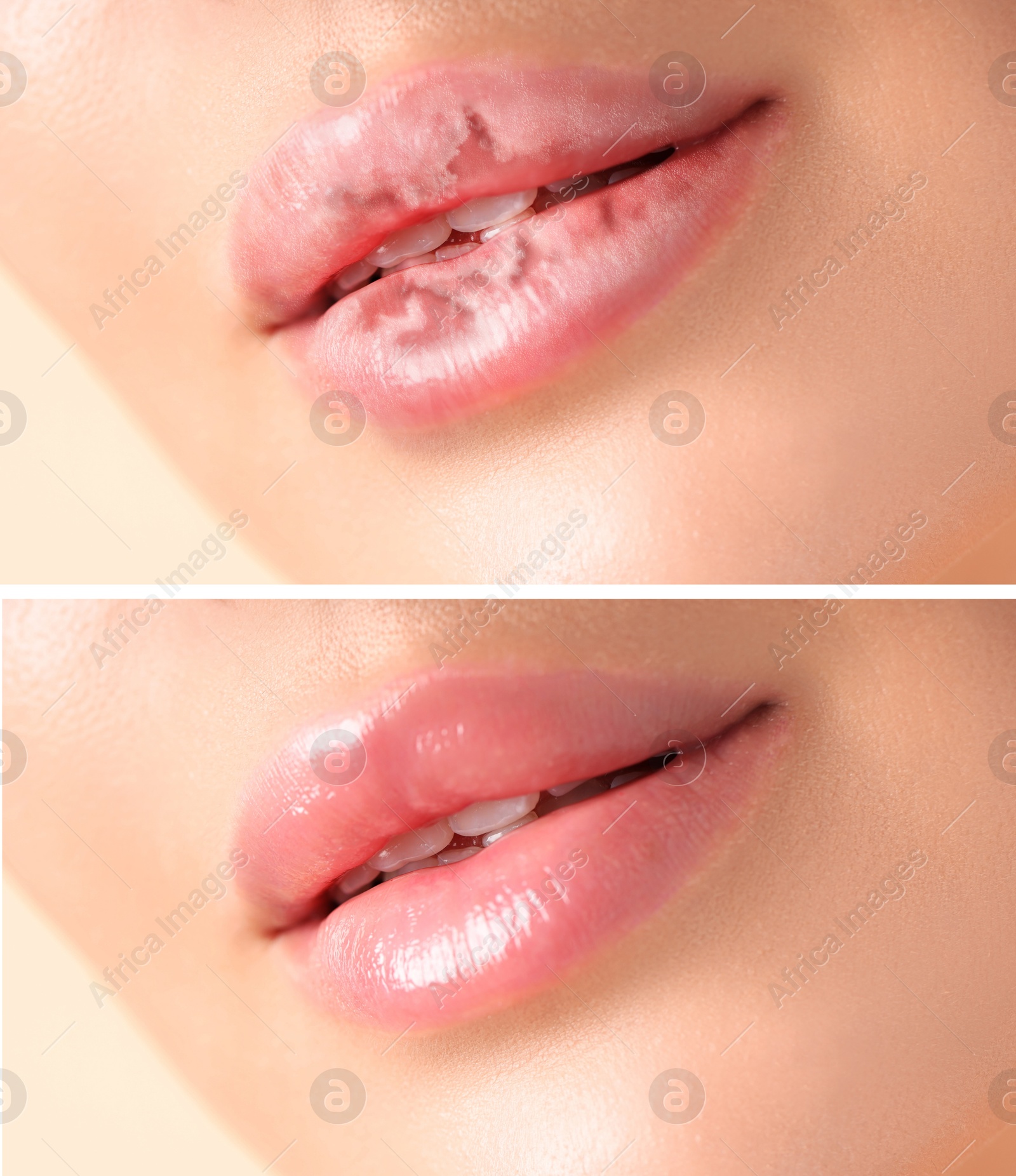 Image of Lip care. Woman with chapped and dry skin before and healthy skin after moisturizing treatment, collage