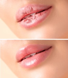 Image of Lip care. Woman with chapped and dry skin before and healthy skin after moisturizing treatment, collage
