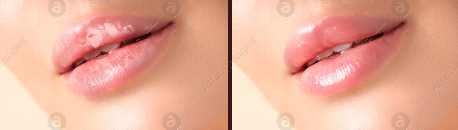 Image of Lip care. Woman with chapped and dry skin before and healthy skin after moisturizing treatment, collage