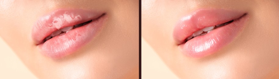 Image of Lip care. Woman with chapped and dry skin before and healthy skin after moisturizing treatment, collage