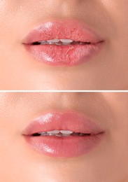 Image of Lip care. Woman with chapped and dry skin before and healthy skin after moisturizing treatment, collage