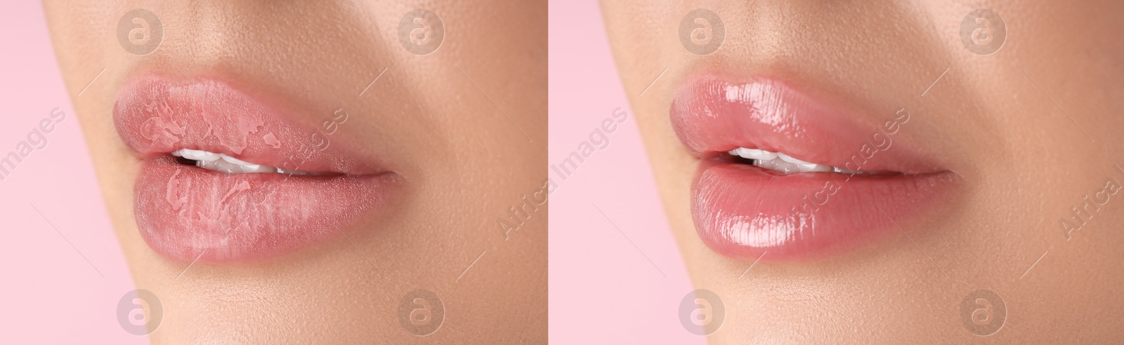 Image of Lip care. Woman with chapped and dry skin before and healthy skin after moisturizing treatment, closeup. Collage on pink background