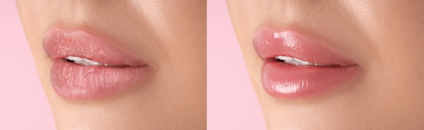 Image of Lip care. Woman with chapped and dry skin before and healthy skin after moisturizing treatment, closeup. Collage on pink background