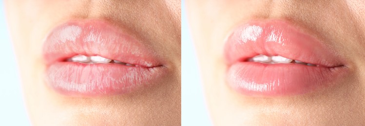 Image of Lip care. Woman with chapped and dry skin before and healthy skin after moisturizing treatment, collage