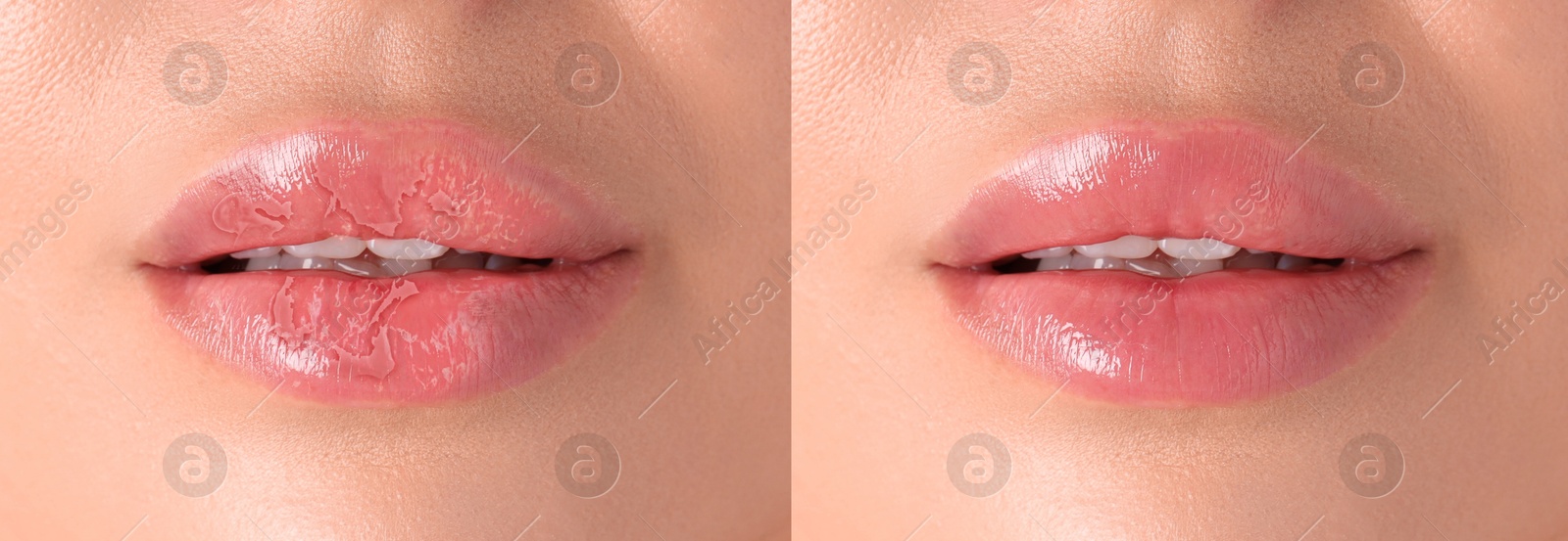 Image of Lip care. Woman with chapped and dry skin before and healthy skin after moisturizing treatment, collage